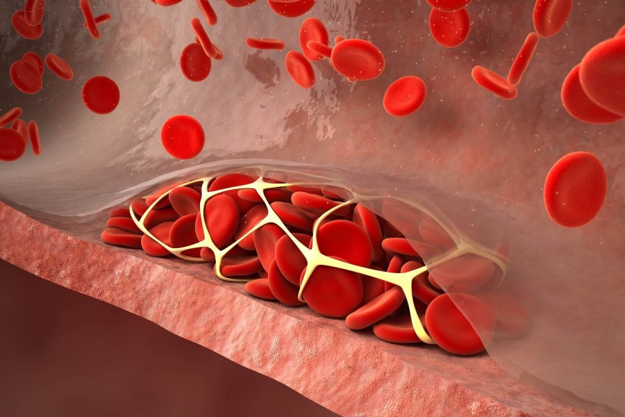 Профмеры после COVID-19 для предотвращения развития тромбозов показаны даже молодым – гематолог
